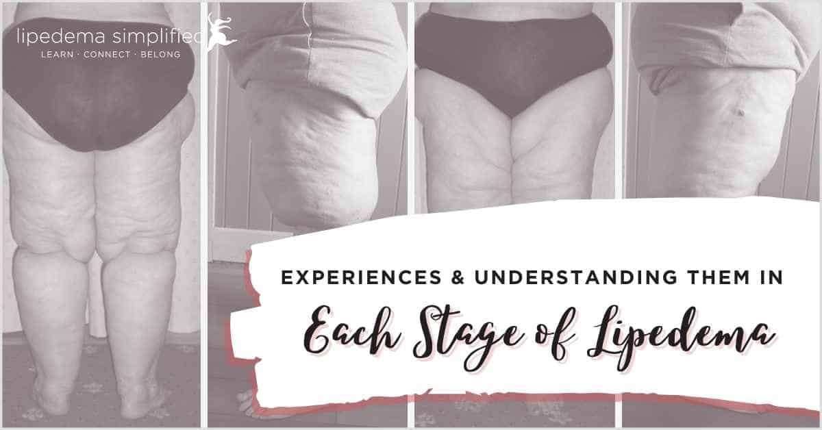 Talk Lipoedema - Stages of Lipoedema Stage I 1. Skin is smooth 2