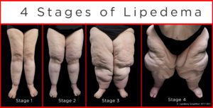 4stages-lipedema