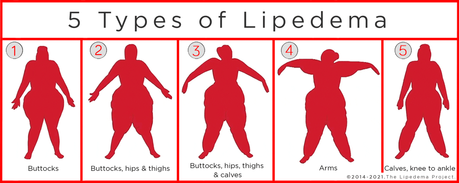 5types-lipedema - Lipedema Simplified