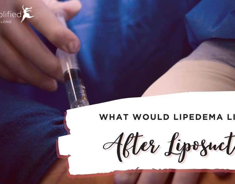quality-of-life-after-liposuction