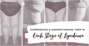 each stage of lipedema