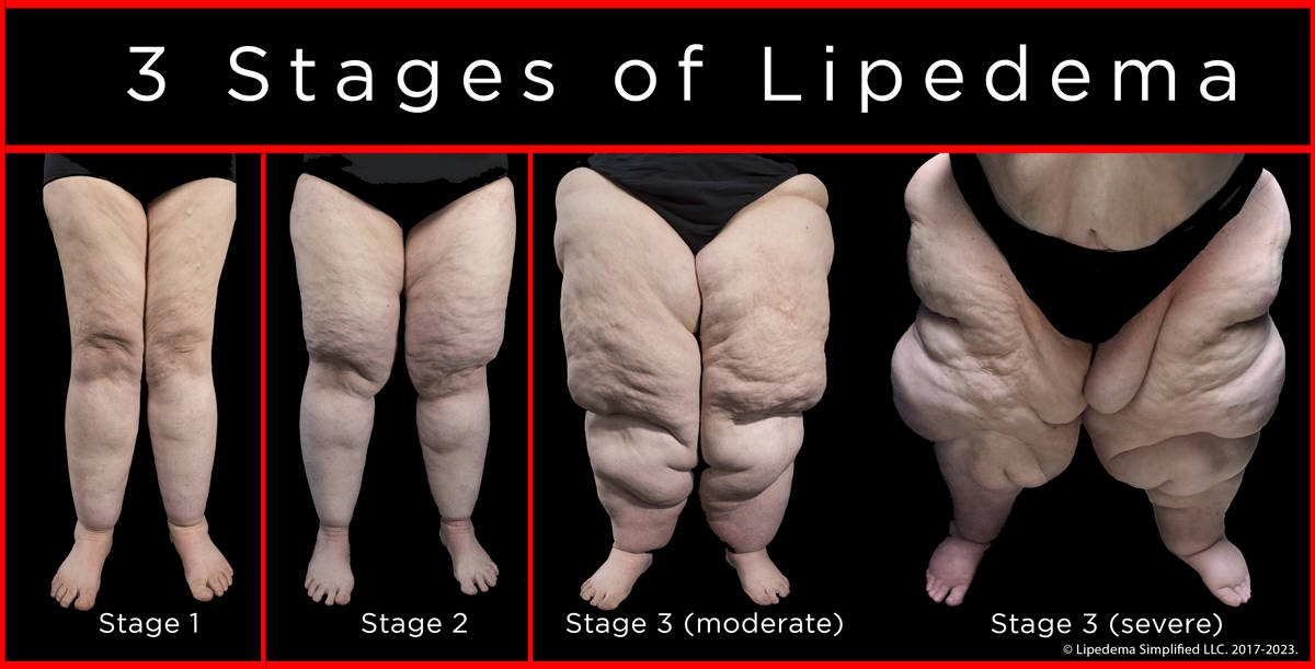 3stages2-lipedema-red-copyright-full-may2023
