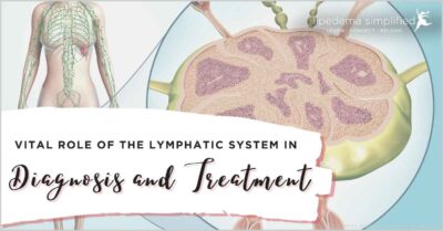 role of lymphatics in lipedema diagnosis and treatment