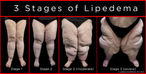 Stages. symptoms, causes of lipedema