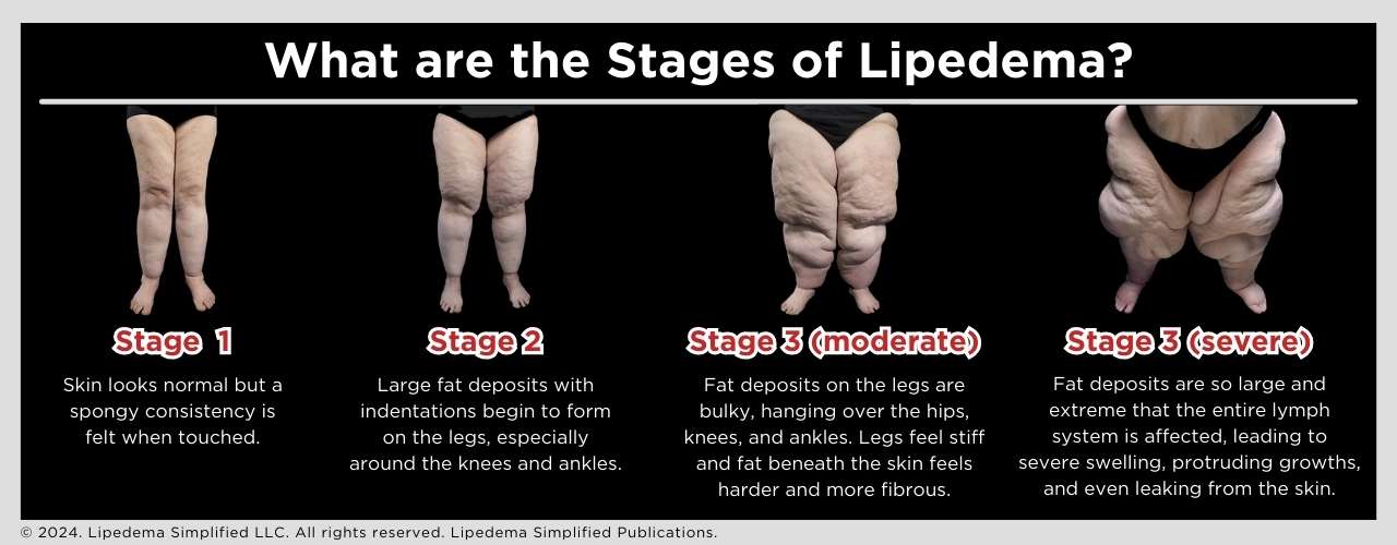 What is Lipedema - Three stages of Lipedema that shows what leg look like for every stage